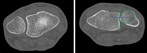 Ct Of Both Wrists With Dorsal Subluxation Of The Left Ulna Head Download Scientific Diagram