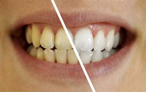How To Make Natural Homemade Teeth Whitener
