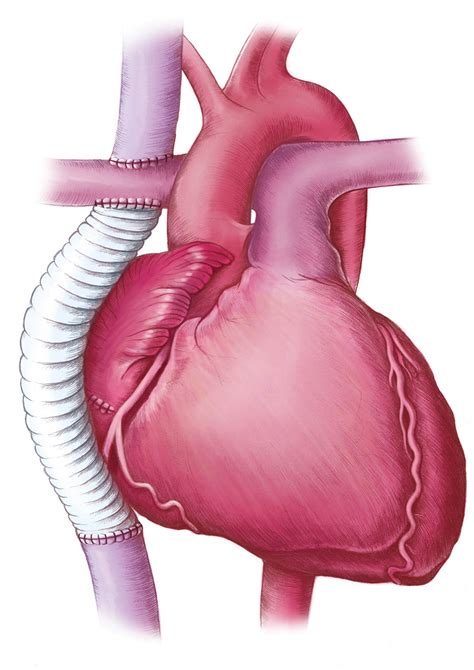 Fontan Procedure Published In Emj Cardiology On Behance