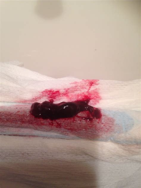 Are blood clots normal during your period? is this a blood clot or tissues from the miscarriage - Glow Community