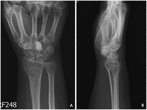 Frontiers Solitary Calcified Nodules As The Cause Of Carpal Tunnel
