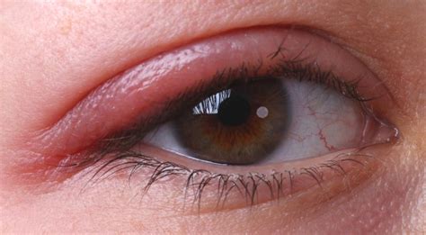 Pimples On Eyelids Causes Symptoms Treatment And Prevention