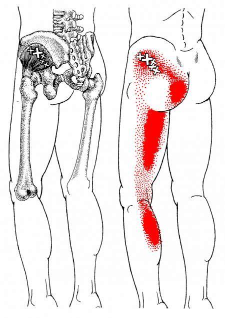 Gluteus Minimus The Trigger Point And Referred Pain Guide Back