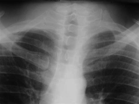 Normal Chest Variants