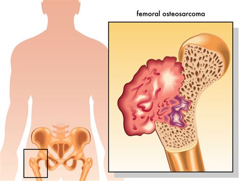 Osteosarcoma Symptoms May Point To A Rare Type Of Cancer University