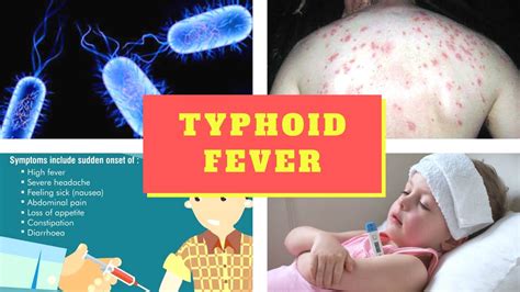 Typhoid Fever Symptoms Causes Symptoms And Pictures Of Enteric Fever