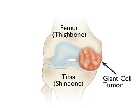 Giant Cell Tumor Of Bone Orthoinfo Aaos