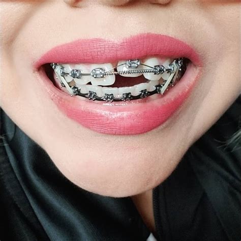 Braces Girlswithbraces Metalbraces Elastics Powerchain Springs Orthodontics Braces