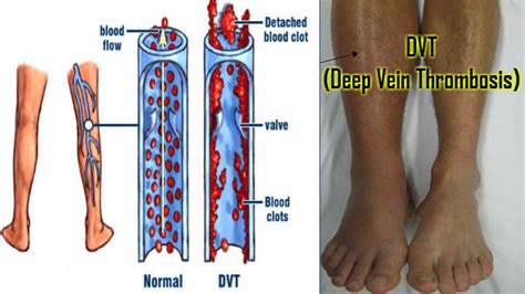 Deep Vein Thrombosis Dvt Sri Sai Speciality Clinic