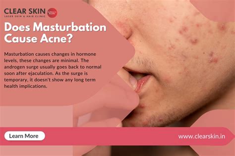 Does Masturbation Cause Acne