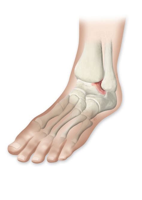 Rheumatoid Arthritis Ra Of The Foot And Ankle Limbhealing