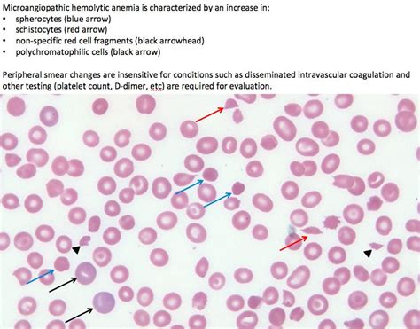 Peripheral Blood Findings In Microangiopathic Hemolytic
