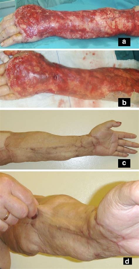 Reconstruction Of Skin Avulsion Injuries Of The Upper Extremity With