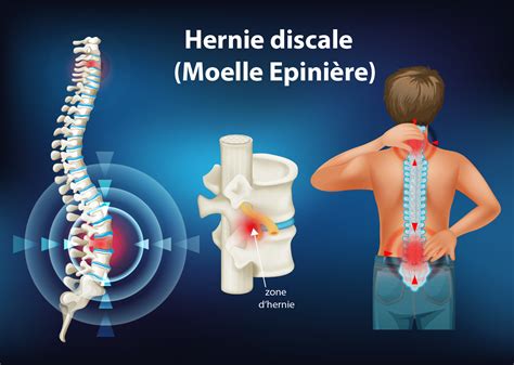 Hernie discale symptômes causes traitements et opération Information hospitalière