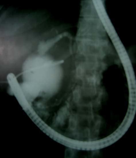 Ercp After Caesarean Section Eight Weeks After Delivery Patient