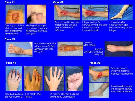The Use Of Artificial Dermis For Complex Wounds