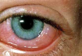 You may develop an allergy after you have been exposed to an allergen more than once. Allergic conjunctivitis | Download Scientific Diagram