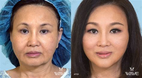 Plastic Surgery Los Angeles