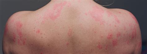 Covid Symptoms Skin Rash Skin Rashes Red Flag Symptoms Gponline