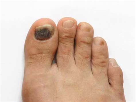 Runners Toe And How To Treat It