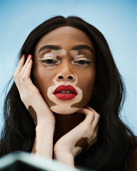 The Best Skin Care Tips For Vitiligo From Top Derms Winnie Harlow