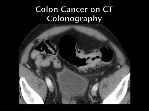 Ppt Imaging Of Colon Cancer Powerpoint Presentation Free Download Id 5621044