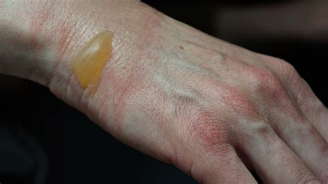 Close Up Of A Woman S Hand With A Blister From A Boiled Water Burn