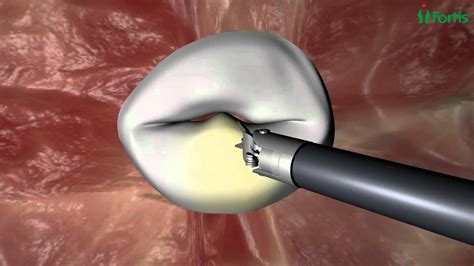 Endoscopic Mitral Valve Repair Procedure Animation Youtube