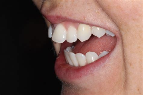 Aligner Behandlung Bad Segeberg Unsichtbare Zahnsange
