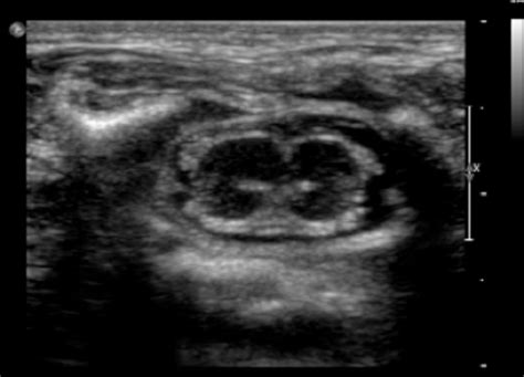 The Spinal Cord: Ultrasound Of The Spinal Cord
