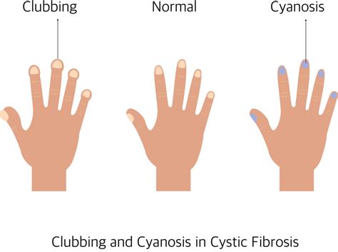 Cystic Fibrosis Causes Signs Symptoms And Treatment