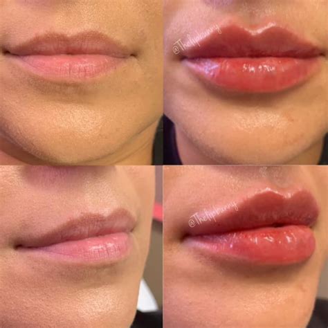 Perfect Lip Fillers Lip Fillers Perfect Lips Dermal Fillers Lips