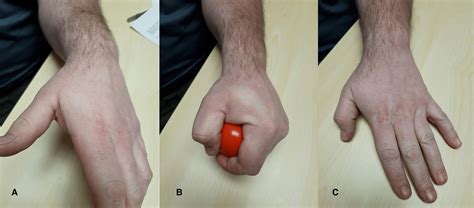 Cureus Chronic Exertional Compartment Syndrome Of The Hand With