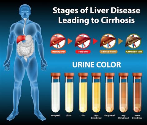 Free Vector Stages Of Liver Disease