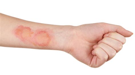 Skin Infection Heres Everything You Need To Know Healthkart