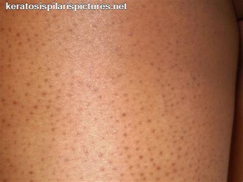 Skin Keratosis Pilaris Dorothee Padraig South West Skin Health Care