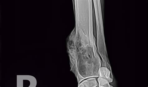 Lameness caused by osteosarcoma is typically mild at the onset, but then progresses over time. Osteosarcoma in Dogs | PetCoach