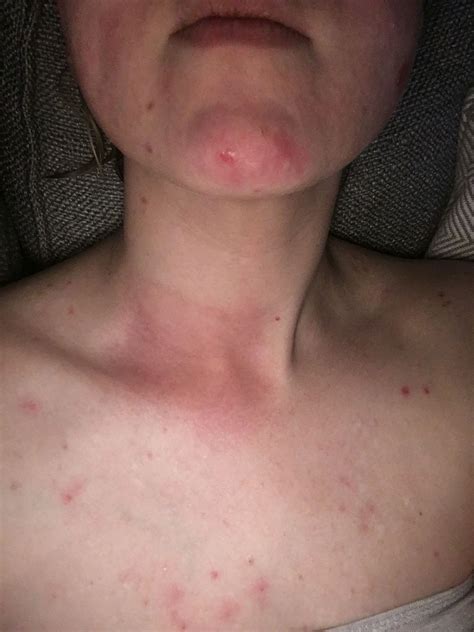 Pin On Rash Directly Over Thyroid Neck Pain