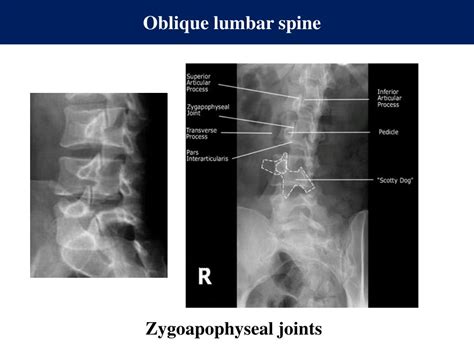 Lumbar Spine Oblique View