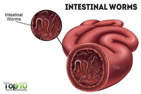 Home Remedies For Intestinal Worms Liberteon