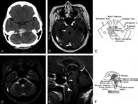 A Noncontrast Ct Of A 48 Year Old Woman Who Presented With Dr And Download Scientific Diagram