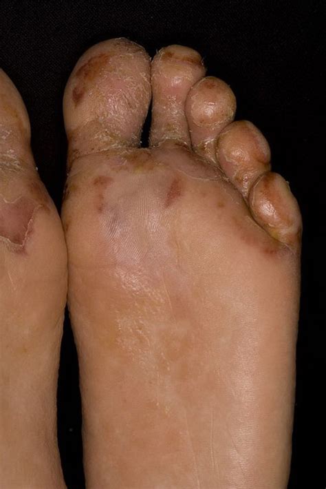 Dyshidrosis Foot Pictures 18 Photos And Images