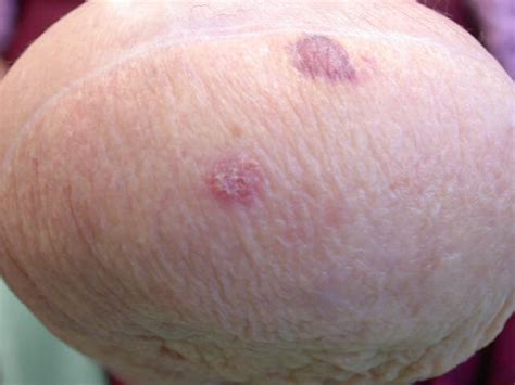 What causes a basal cell carcinoma? Skin Cancer Pictures | Most Common Skin Cancer Types with ...