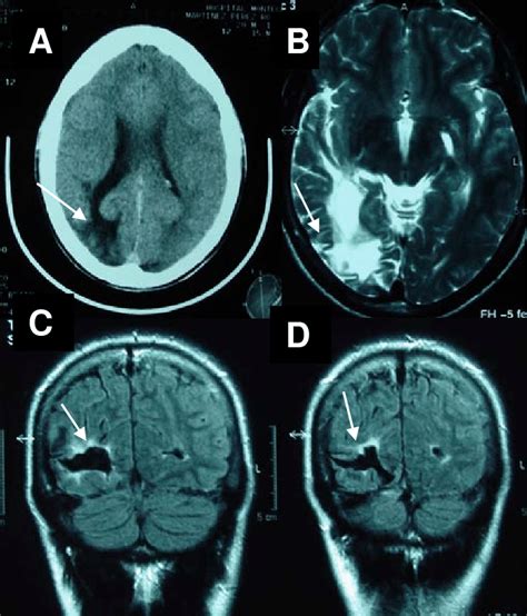 A Brain Ct Hypodense Right Occipital Lobe Lesion Arrow With