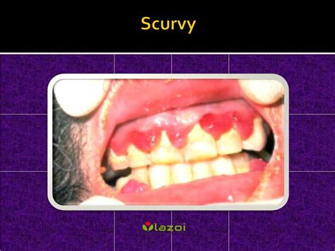 Ppt Scurvy Causes Symptoms Daignosis Prevention And Treatment