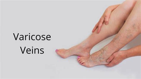Varicose Veins Causes Symptoms And Best Treatment Methods