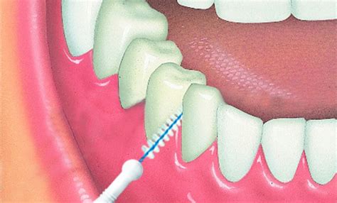 ¿qué Son Y Cómo Se Utilizan Los Cepillos Interdentales Blog Dentista