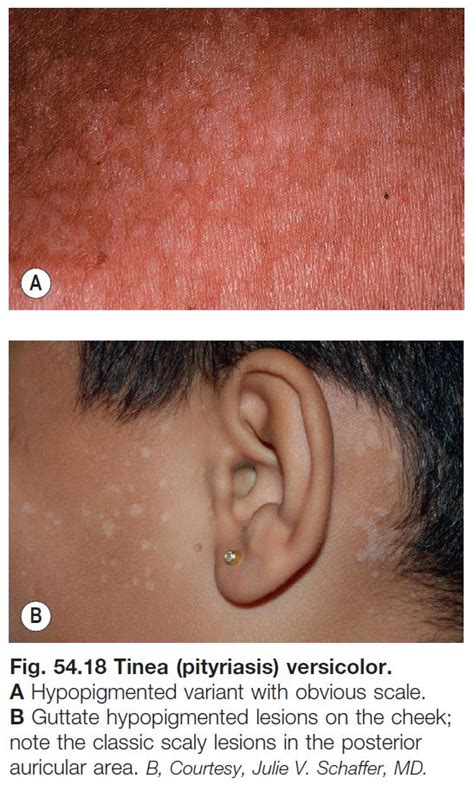 Idiopathic Guttate Hypomelanosis Vs Tinea Versicolor