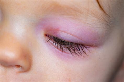 14 Early Warning Signs Of Blepharitis Page 8 Of 15