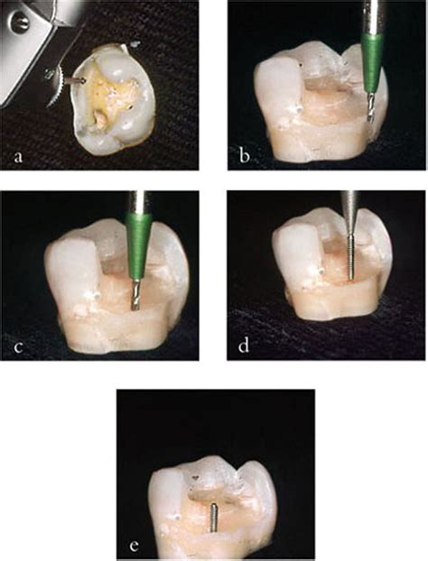 3 Retention Of Cores Pocket Dentistry